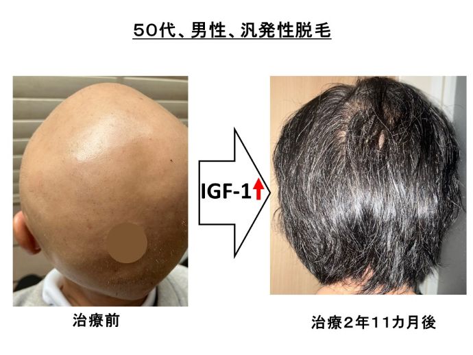 円形脱毛症　病院